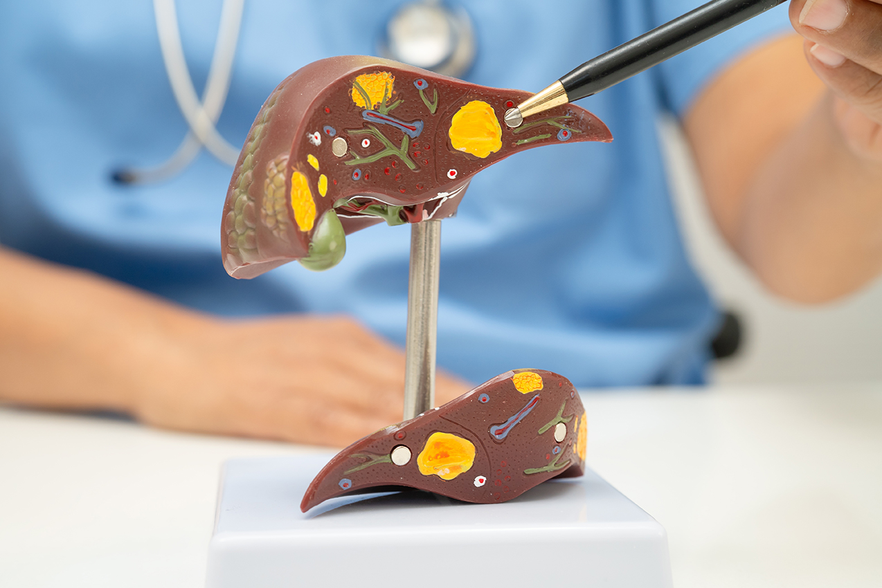 Doctor pointing to a medical display during consultation, illustrating liver conditions including fatty liver disease. 