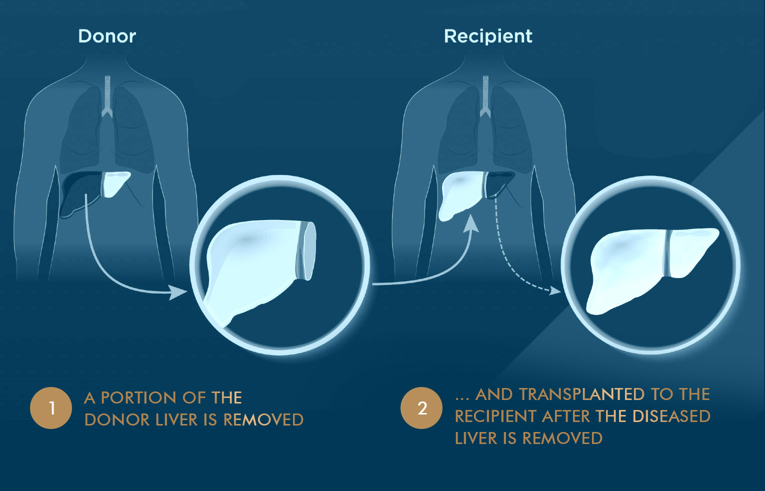 Liver Transplantation