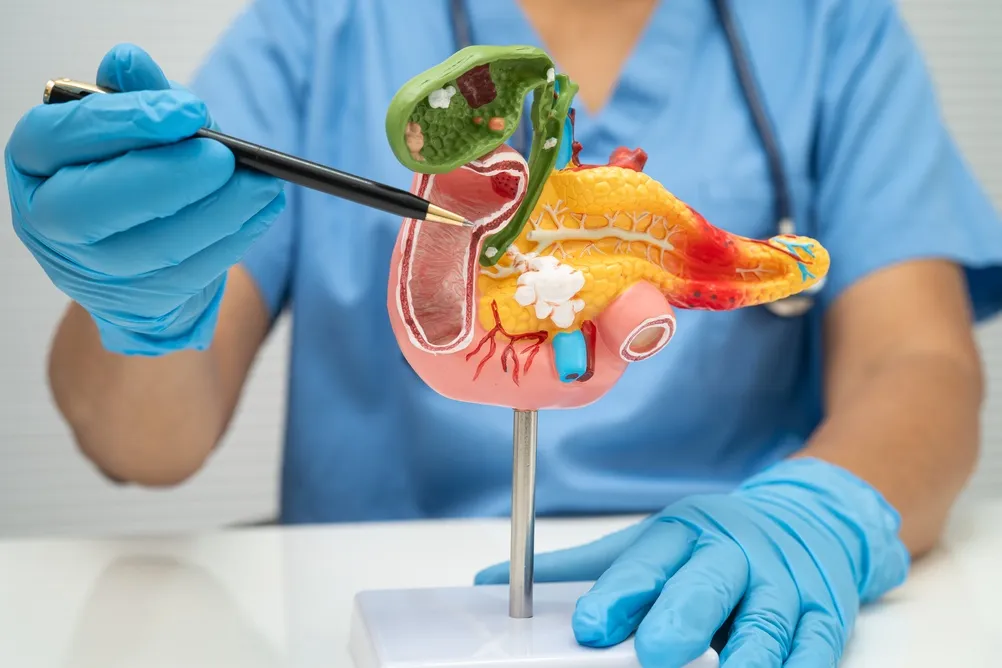 Doctor pointing out pancreatic cancer on an anatomical model