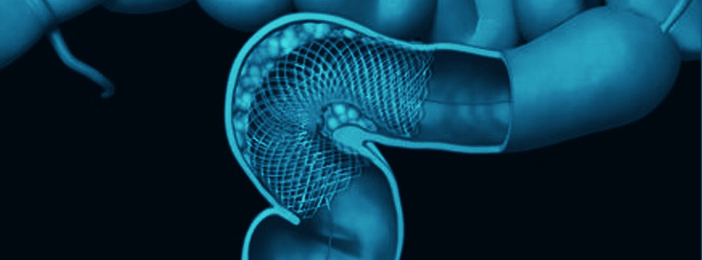 Colonic Stenting Procedure