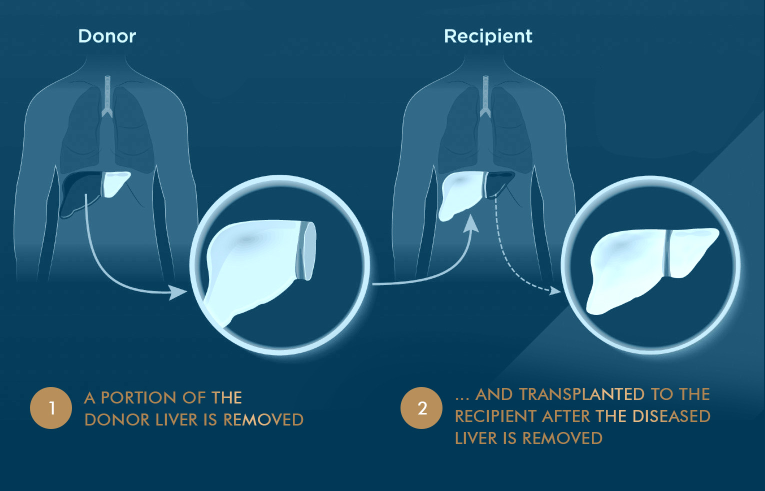 Liver Transplantation Singapore