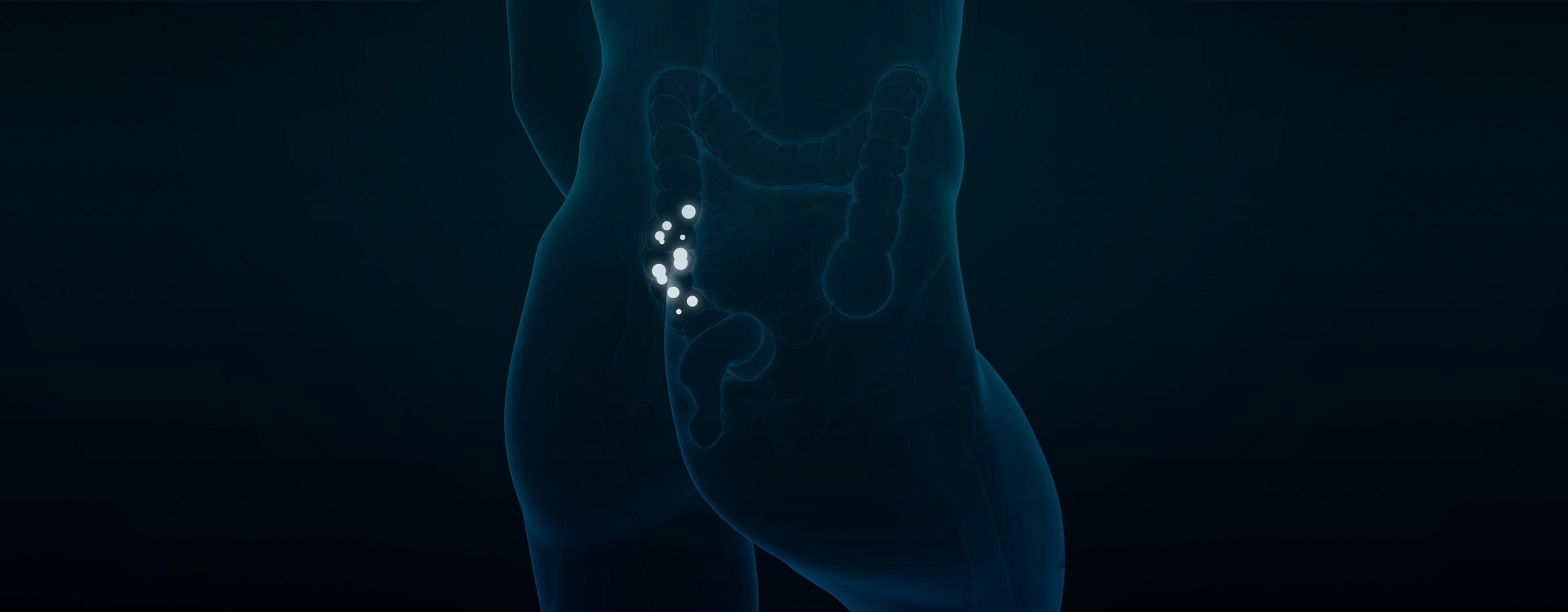 Diverticular Disease