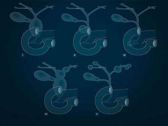 Bile Duct Cysts