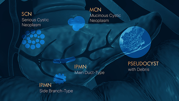 Cysts in Pancreas