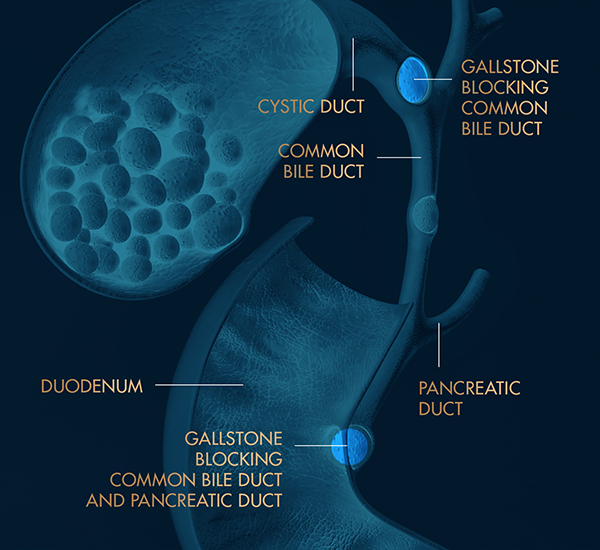 Bile Duct Stones