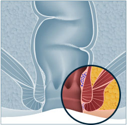 Piles Haemorrhoids Surgery Singapore