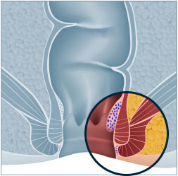 Haemorrhoids Treatment Singapore