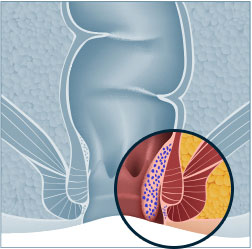 Haemorrhoids Surgery Treatment