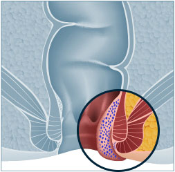 Piles Surgery Singapore