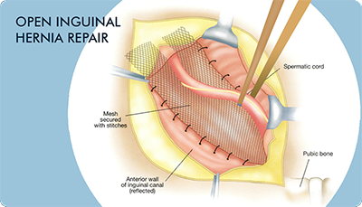 Open Hernia Surgery Repair