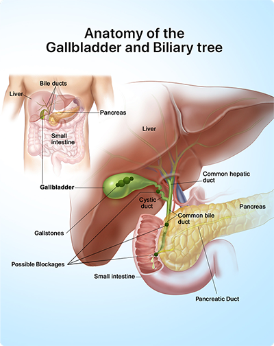 Gallbladder Removal Surgery - Cholecystectomy