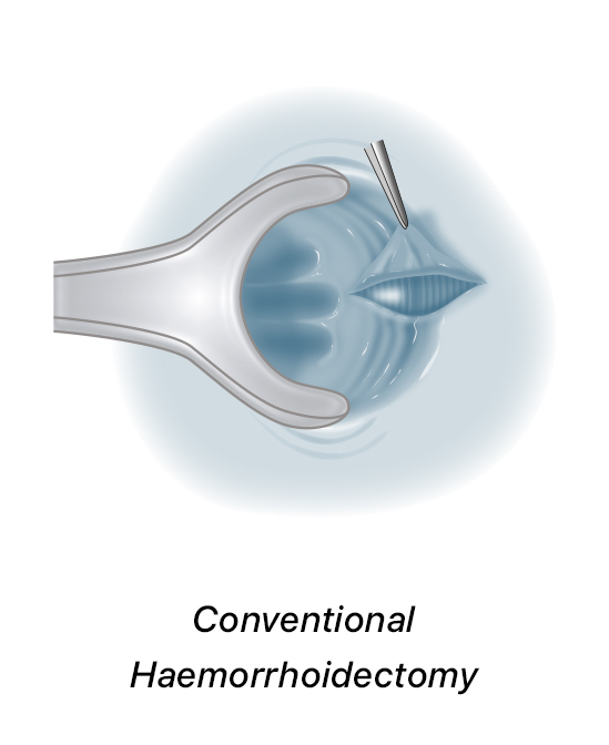 Conventional Haemorrhoidectomy