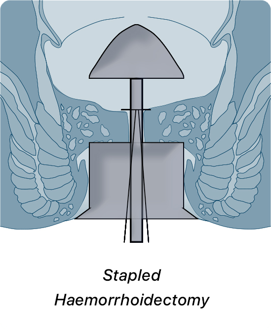 Stapled Haemorrhoidectomy