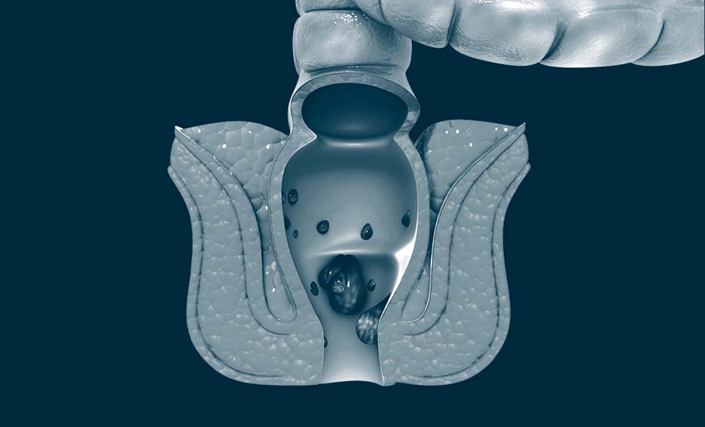 Haemorrhoidectomy Singapore